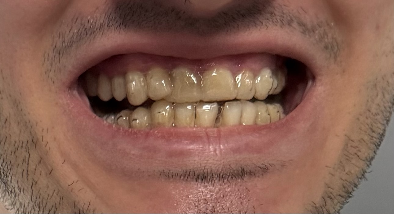One month with aligners – feeling a good change already